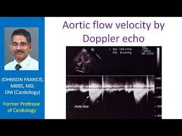 Aortic Flow Velocity By Doppler Echo