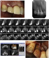 diagnosis of vertical root fracture