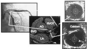 electron beam computed tomography