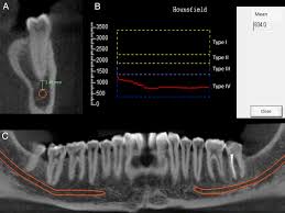 root apex and the mandibular c