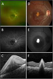 accidental macular injury with class