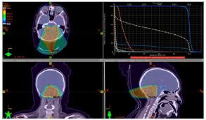 range modulation in proton therapy