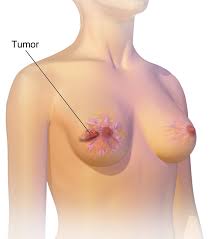 T Cancer Wikipedia