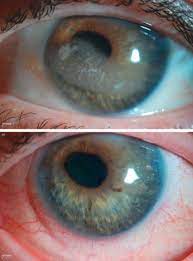 Anterior Corneal Dystrophy An