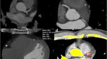 low radiation dose calcium scoring