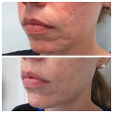 acne scar treatment chevy chase md