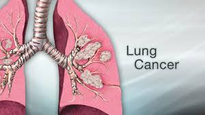 Lung Cancer Information Mount Sinai