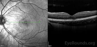 eyerounds org laser pointer maculopathy