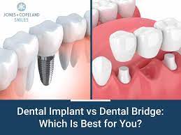 dental bridge or dental implant which