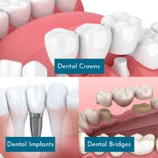 bridges on implants and natural teeth