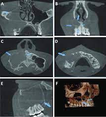 cbct scans of the radicular cyst