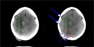 reduction of beam hardening artifacts