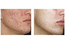 laser acne treatment vbeam