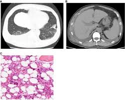 Case Report A Case Of Tafro Syndrome