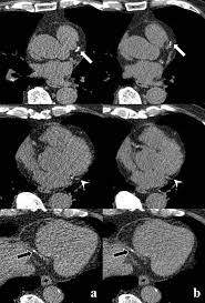 coronary artery calcium scores