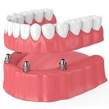 all on 4 dental implants revolutionary