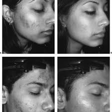 pdf laser treatment of acne vulgaris