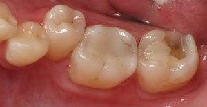 disadvantages of dental implants the cons