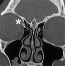 frontal sinusitis