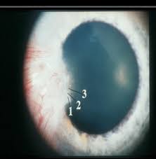 Ocular Disease I Corneal Dystrophies