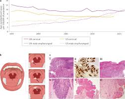 Hpv Associated Oropharyngeal Cancer