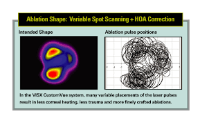 custom vision lasers outshine broad beam