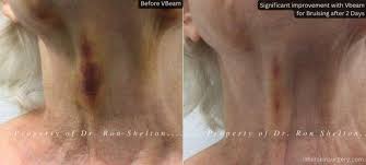 vbeam laser nyc before and after