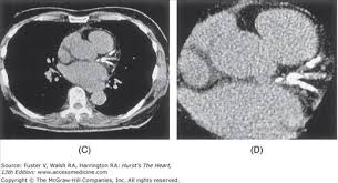 computed tomography of the heart