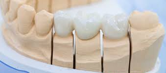 dental implants vs bridges gordon