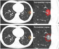 Lung Adenocarcinoma