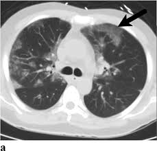 Ground Glass Opacities In The Covid Era