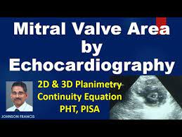 Assessment Of Mitral Valve Area By