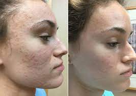 laser acne treatment for young female