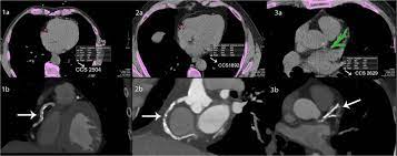 high coronary calcium score