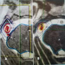 evaluation of cyberknife radiosurgery