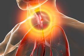 photon therapy in esophageal cancer