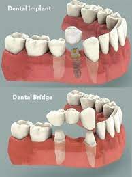 dental implant vs dental bridge which