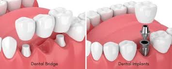 tooth replacement options you pa