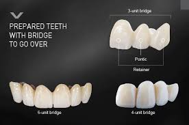 dental bridge over a dental implant
