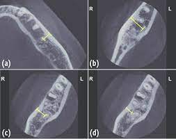 mandibular axial cone beam computed