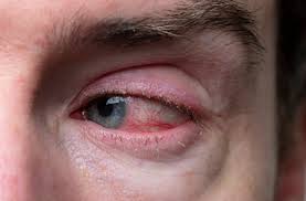 blepharitis vs pink eye know the