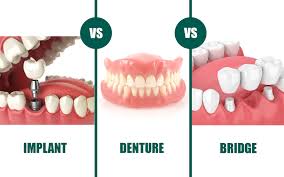 denture vs implant bridge how to