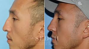 asian rhinoplasty before after photos