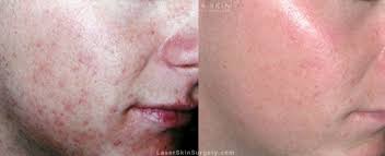acne pimples guide causes new york