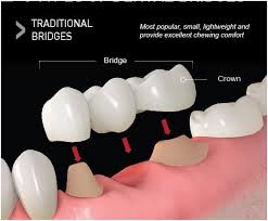 types of dental bridges what type of