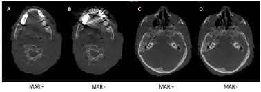 cone beam ct imaging of the paranasal