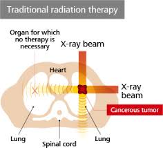 proton beam therapy