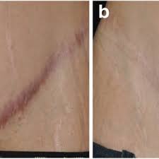 use of lasers in wound healing how to