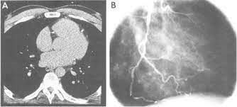 coronary artery calcification