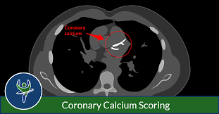 coronary calcium scoring capitol